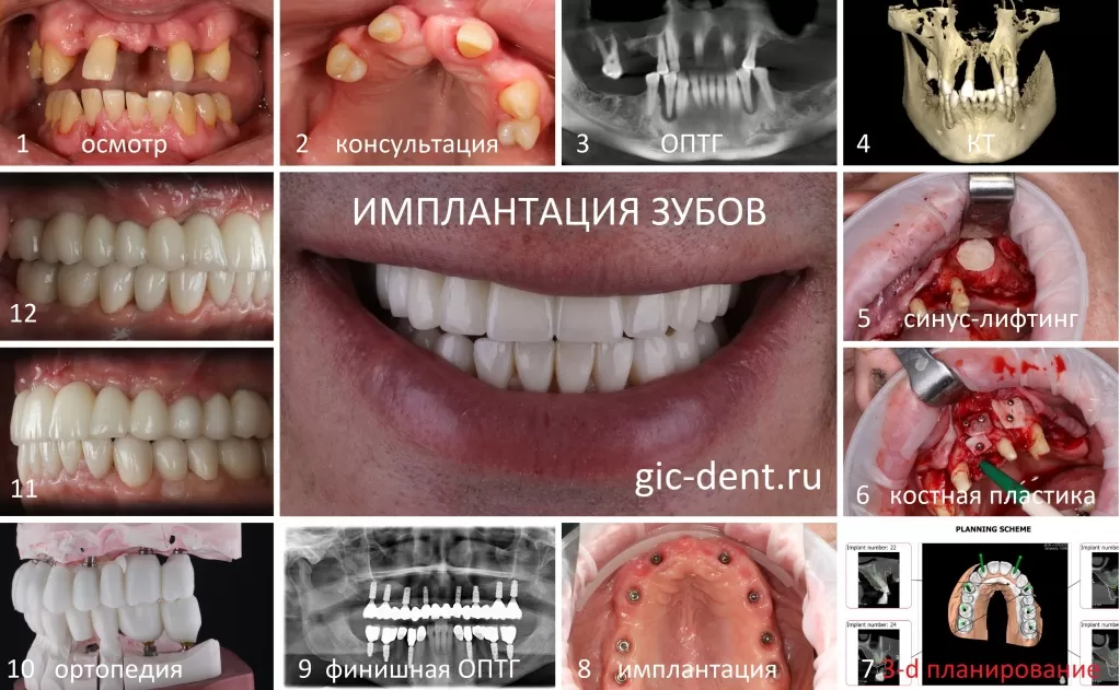 Так, если описывать очень кратко, выглядят этапы имплантации зубов в Немецком имплантологическом центре